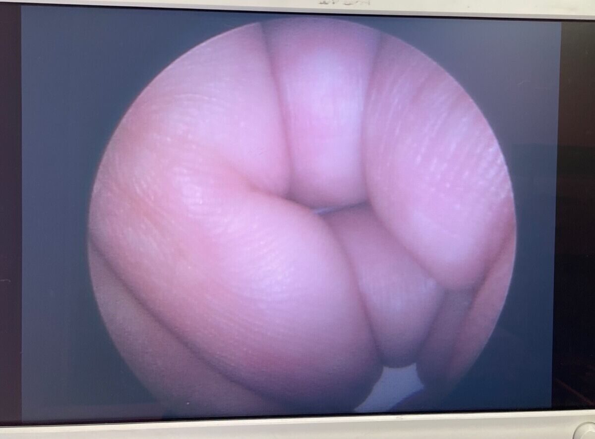 OLYMPUS A2013A Cystoscope — photo 2