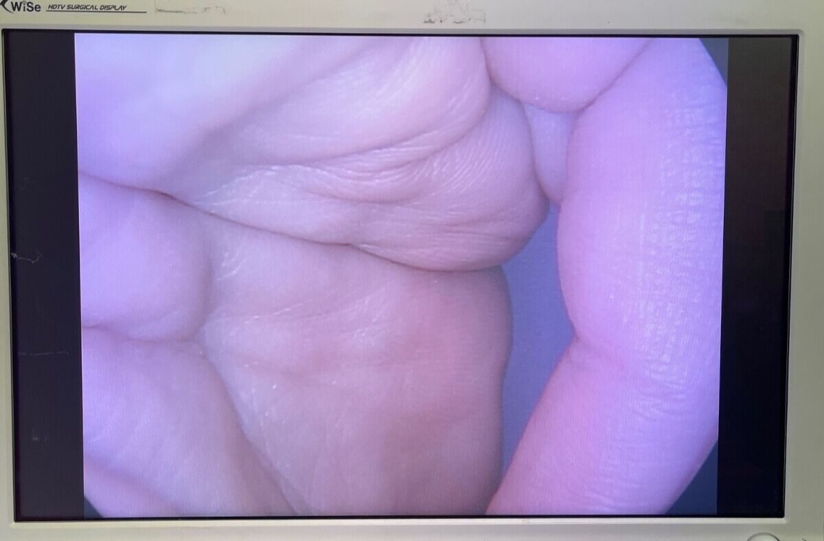 MARLOW SURGICAL  Laparoscope — photo 2