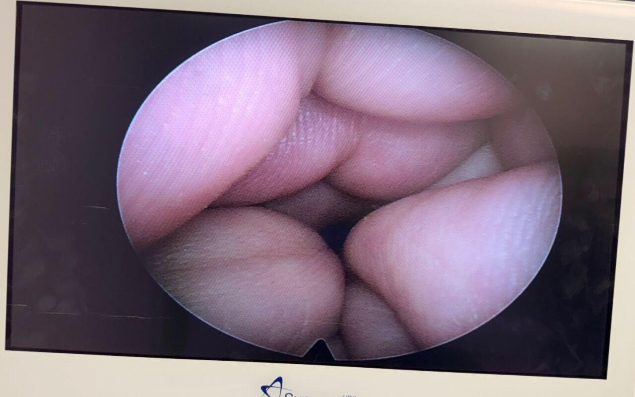 R. WOLF 8986.401 Panoview Plus Laparoscope — photo 2