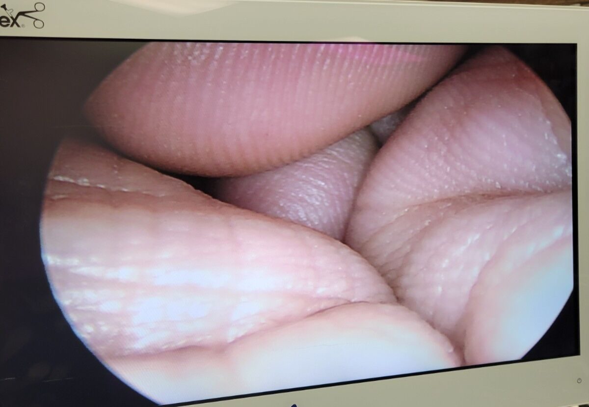 SURGICAL DIRECT SD805-300 5mm High-Definition 30 Degree Laparoscope — photo 9