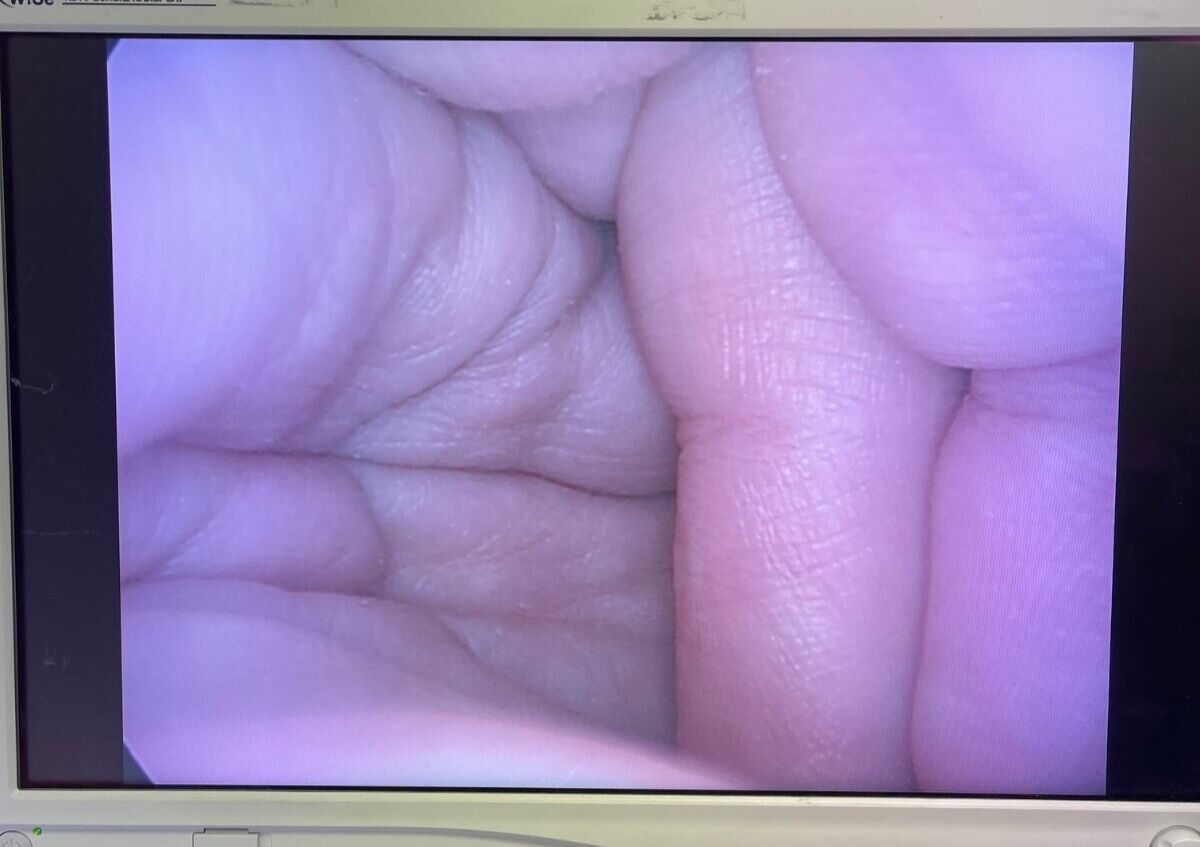 CIRCON LAP 10-0FD Laparoscope — photo 2