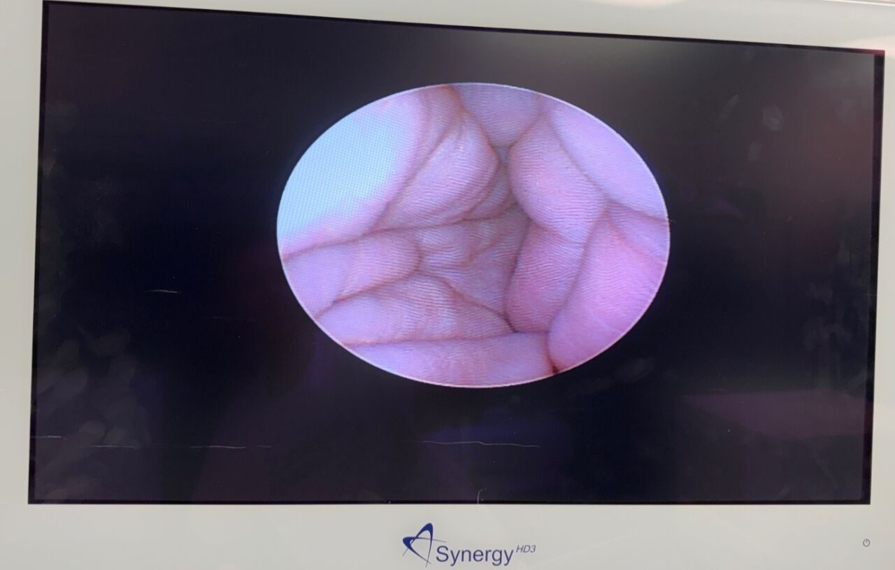 GYRUS ACMI MR-6A Ureteroscope — photo 2