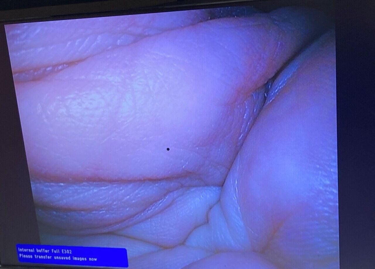 OLYMPUS WA50011A EndoEye HD 10mm x 0° Laparoscope — photo 3