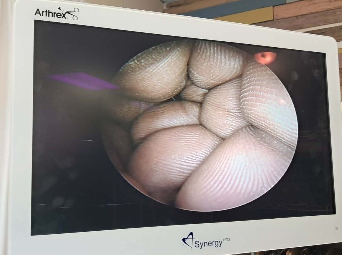GYRUS ACMI OL 10-0A Laparoscope — photo 8